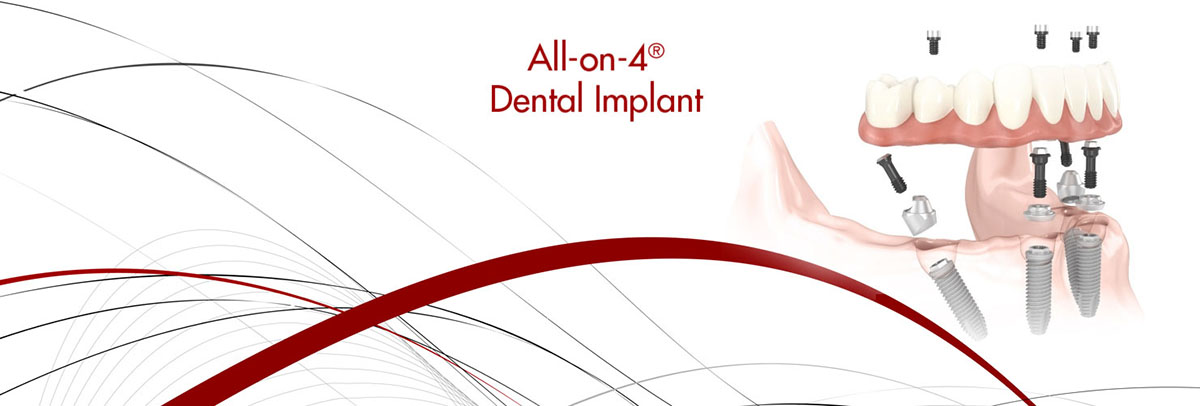 Lincroft All-on-4 Dental Implants
