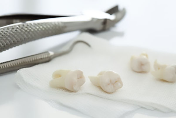 Can A Periodontist Extract A Tooth?