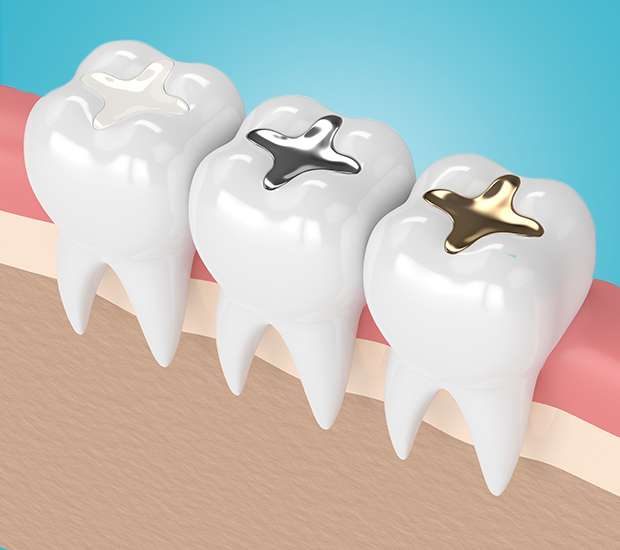 Lincroft Tooth Colored Fillings