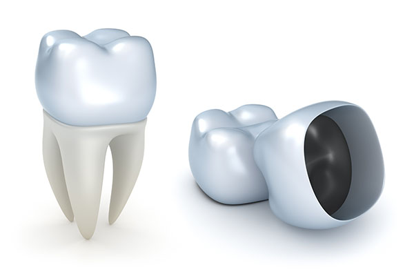 Is a Dental Crown Recommended for Dealing with a Cracked Tooth? from Lincroft Village Dental Care in Lincroft, NJ