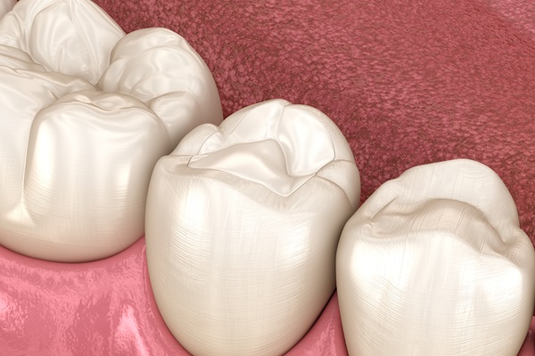 Tooth Colored Dental Filling Options