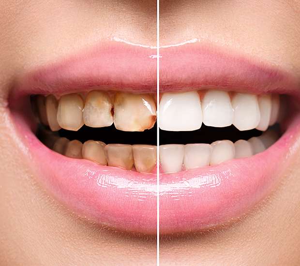 Lincroft Dental Implant Restoration