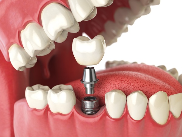 dental implant Lincroft, NJ