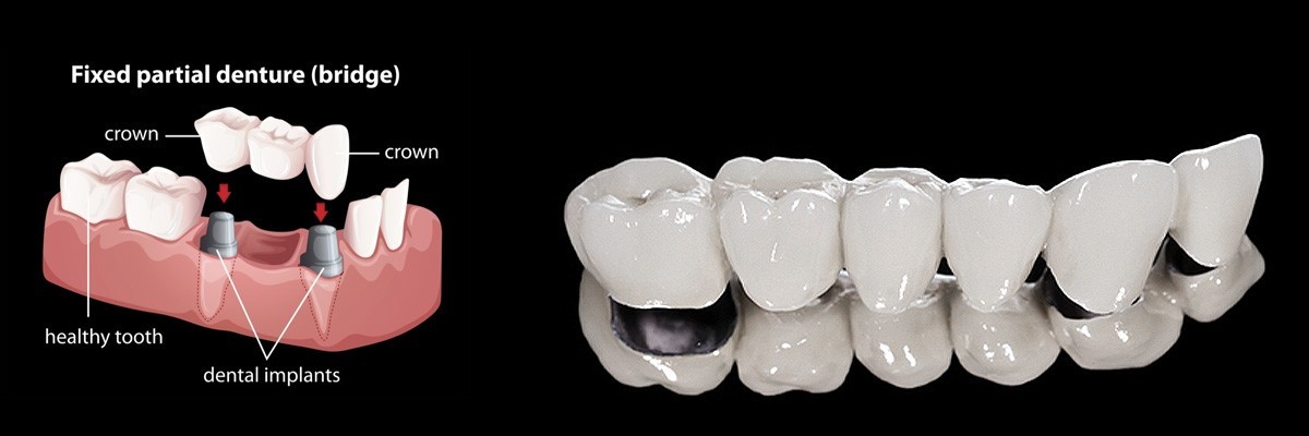 Lincroft Dentures