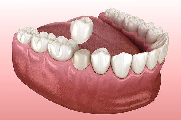 Does a Dental Crown Help After a Root Canal? from Lincroft Village Dental Care in Lincroft, NJ