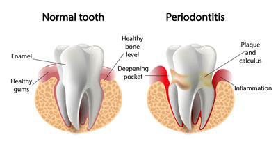 The 5 Stages of Gum Disease: Signs, Symptoms, and Treatment - Old