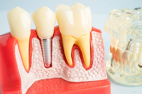 Go To A Periodontist For Dental Implants