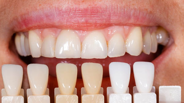 Teeth Whitening Lincroft, NJ