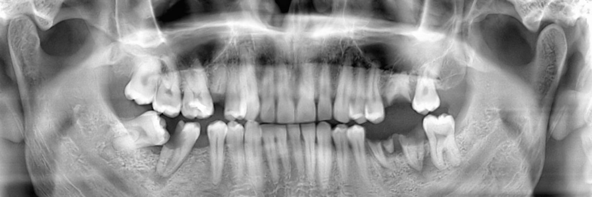 Lincroft Wisdom Teeth Extraction